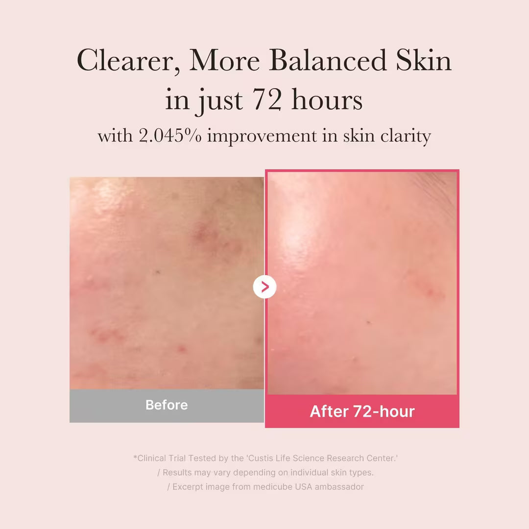 Before and after comparison of skin clarity with text on a beige background