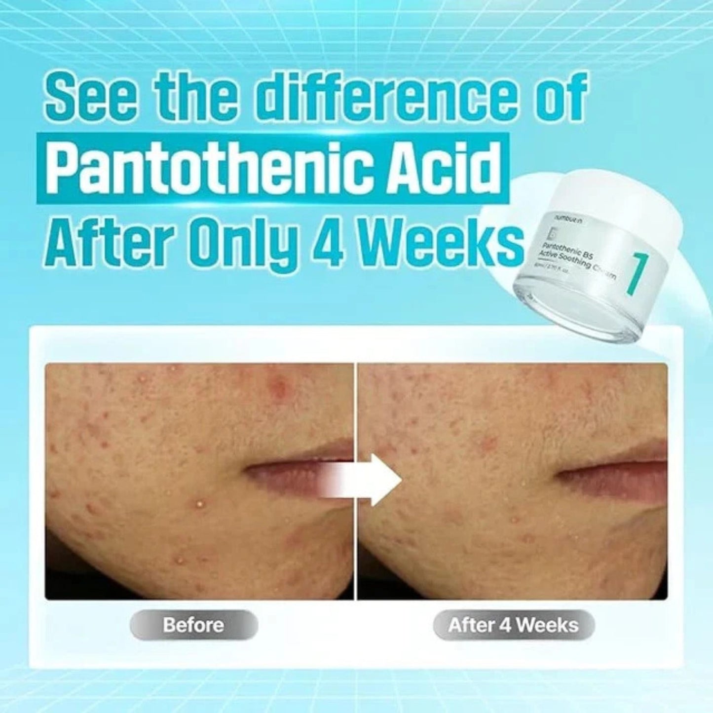 Before and after comparison of skin treatment with pantothenic acid, showing a bottle of cream.
