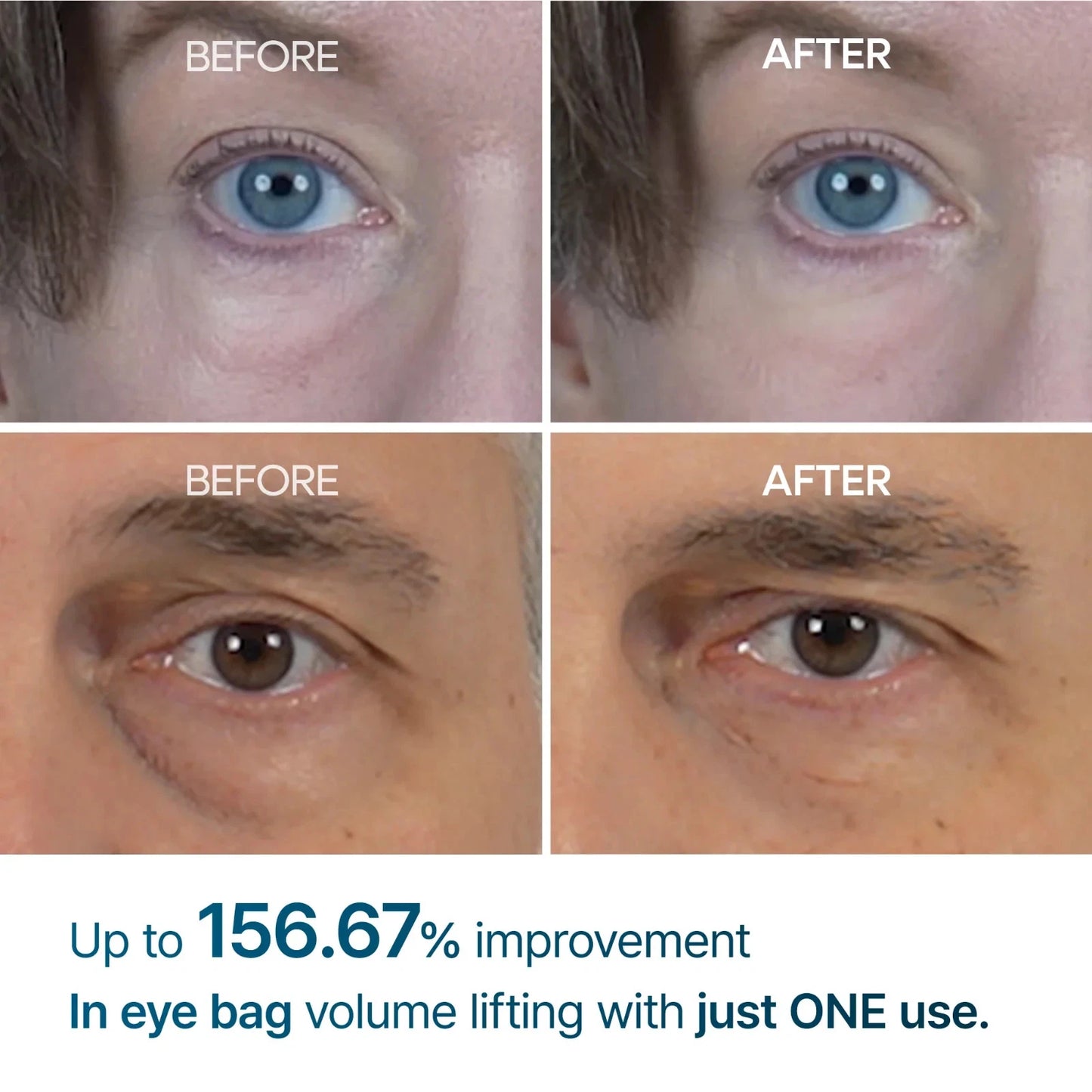 Before and after comparison of eye bags with text indicating improvement.